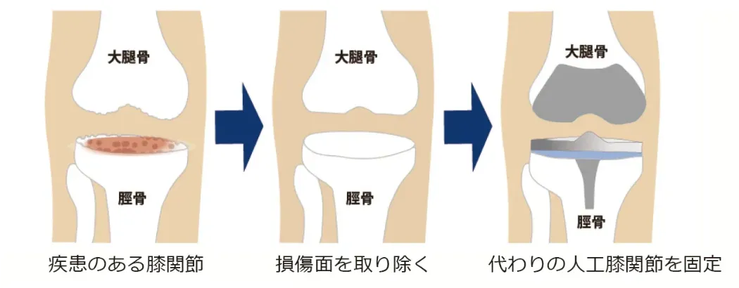 人工膝関節全置換術(TKA)