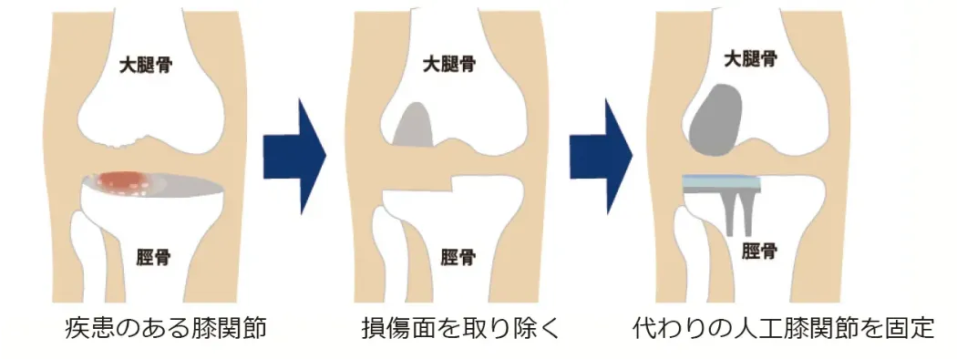人工膝関節部分置換術(UKA)