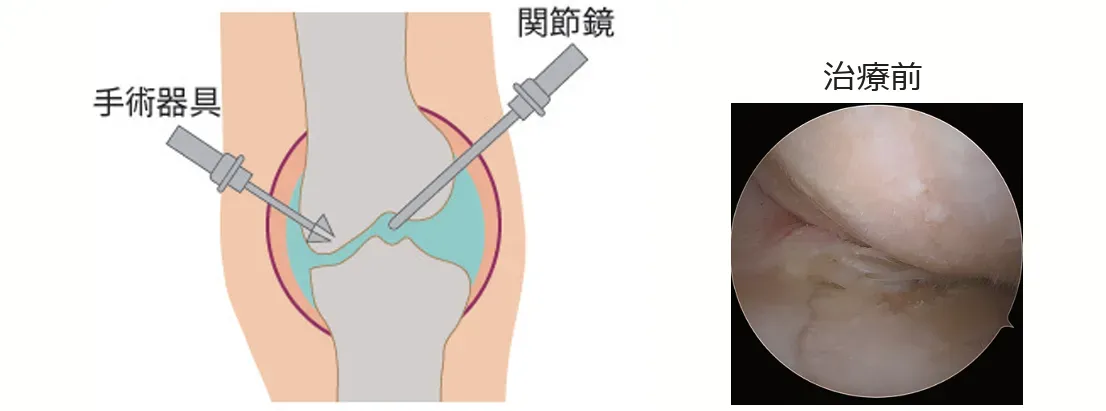 膝関節の中をカメラで覗きながら、軟骨や半月板の損傷部分を処置(低侵襲)