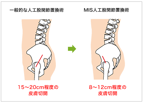 MIS人工股関節置換術