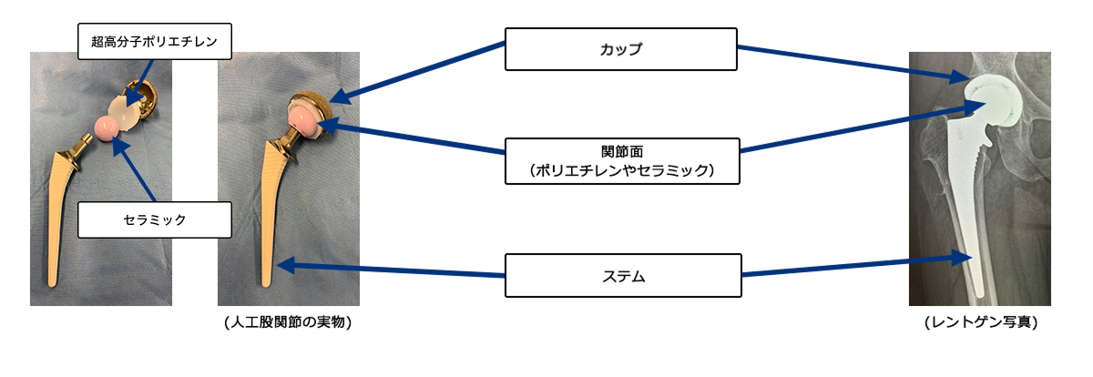 人工股関節置換術」について教えてください | 医療法人社団 新東京石心