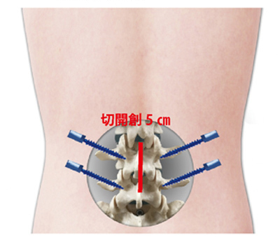 腰椎固定術 MIS-TLIF