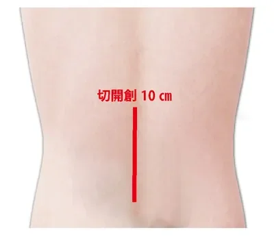 従来の腰椎固定術